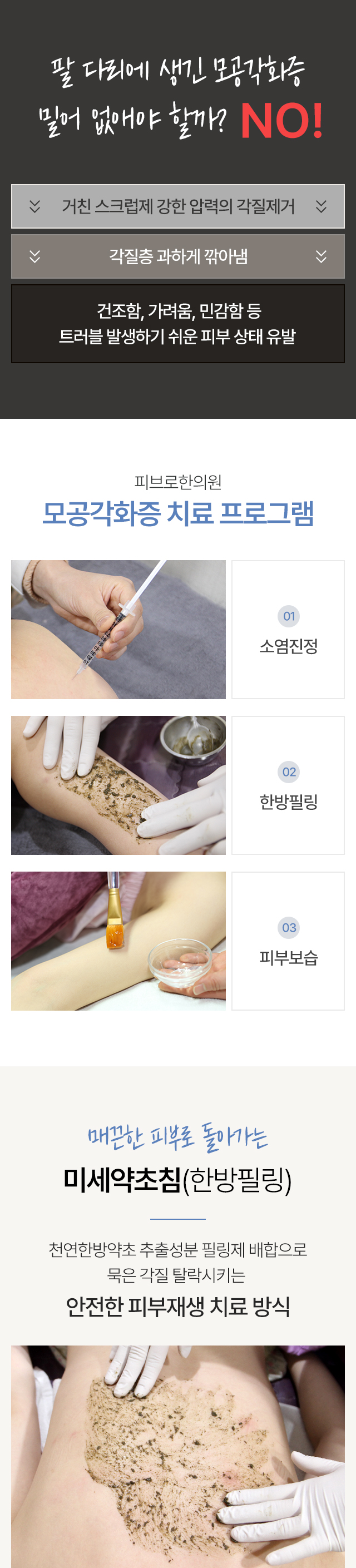 모공각화증 치료